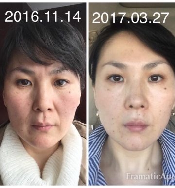 before and after face yoga