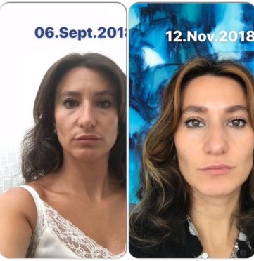 before and after face yoga